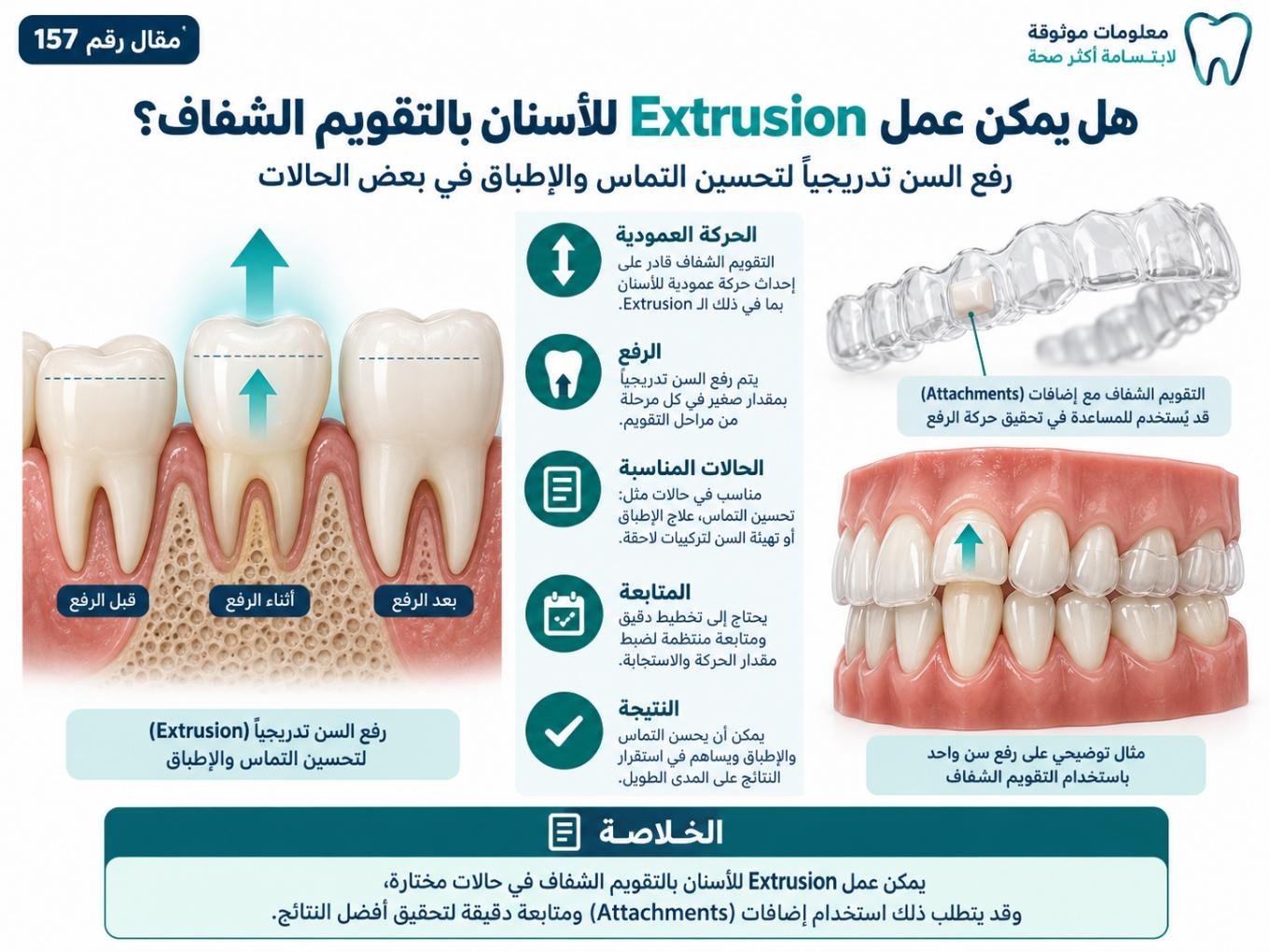 هل يمكن عمل Extrusion للأسنان بالتقويم الشفاف؟