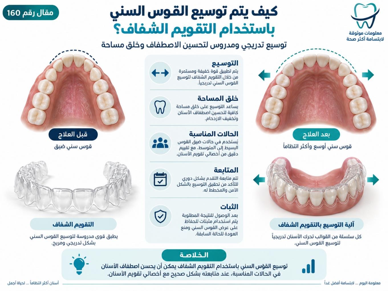 كيف يتم توسيع القوس السني باستخدام التقويم الشفاف؟