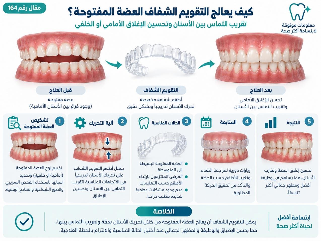 كيف يعالج التقويم الشفاف العضة المفتوحة؟