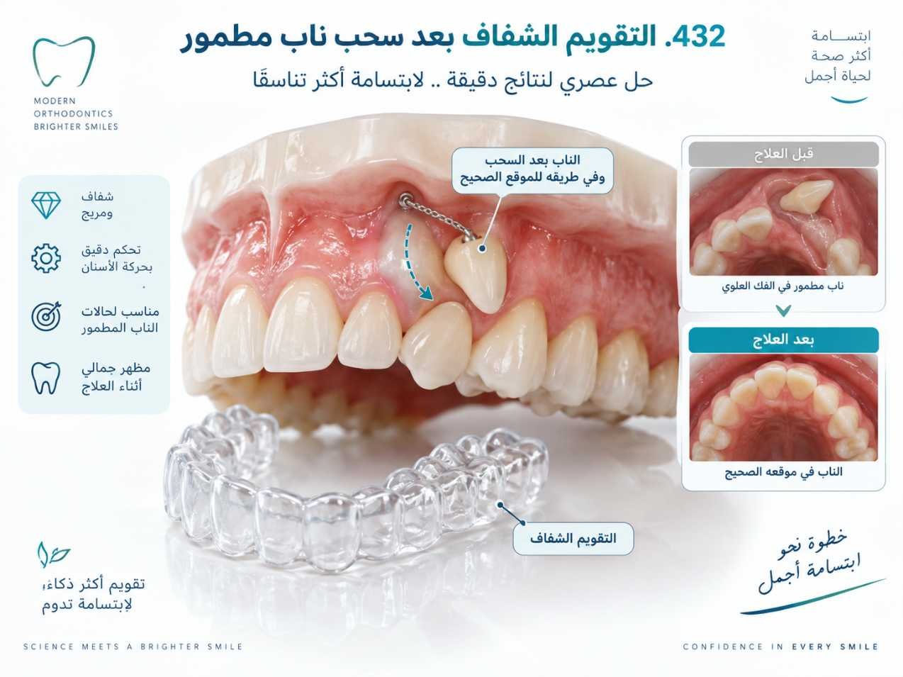 التقويم الشفاف بعد سحب ناب مطمور